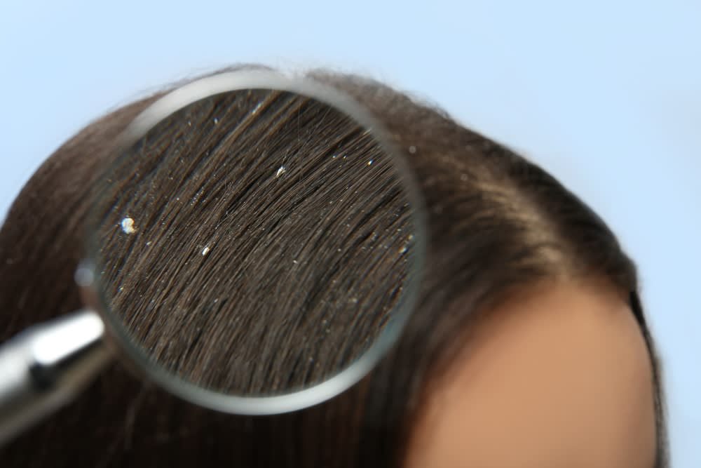 scalp treatment